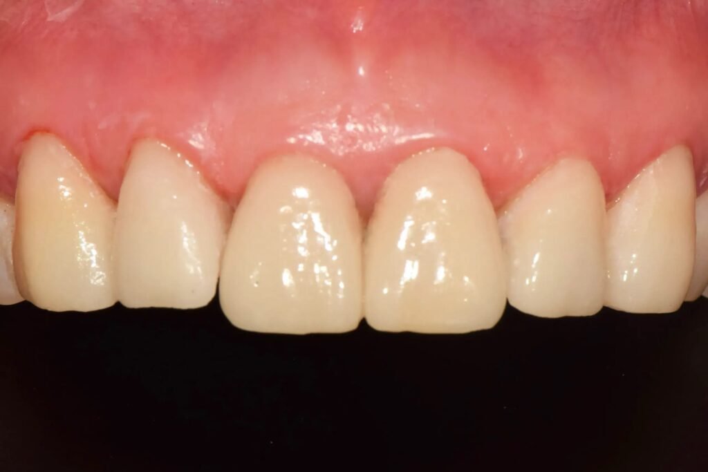 Porcelain veneer result at Arirang Dental Clinic, Kuningan Jakarta