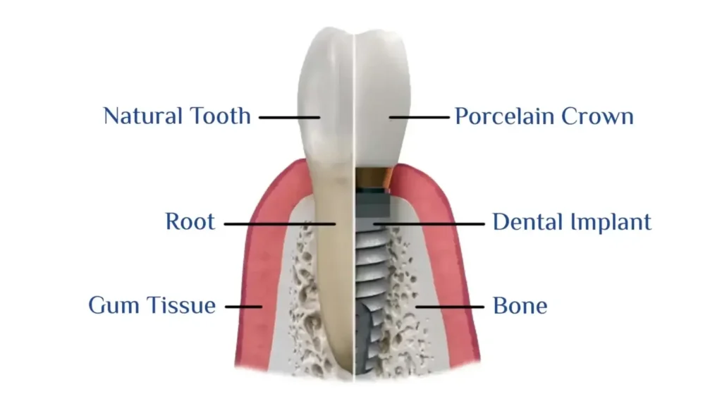 How a dental implant replaces a natural tooth